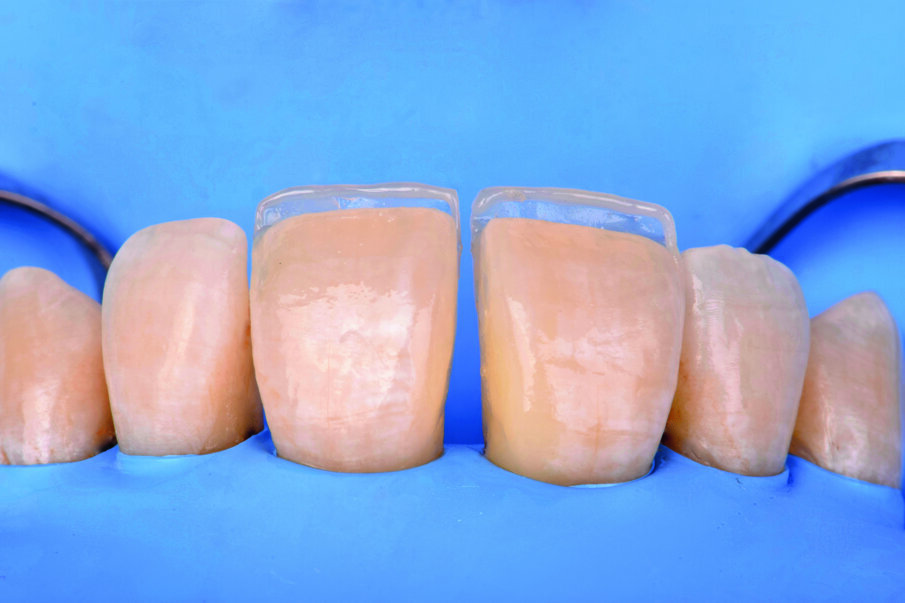 Fig 10. Palatal shell created with Beautifil II Enamel shade T and incisal edge with Beautifil II LS opaque shade A2O