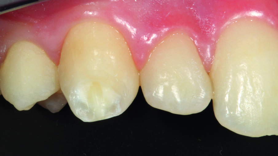Afbeelding 9. Verwijdering van de beschadigde glazuurgebieden zonder het oppervlak te beschadigen.