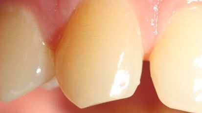 Exposição precoce ao BPA pode afetar negativamente a formação do esmalte dentário