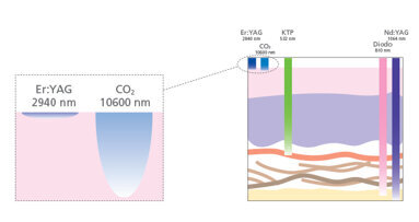 Dispositivi orali e laser per il russamento