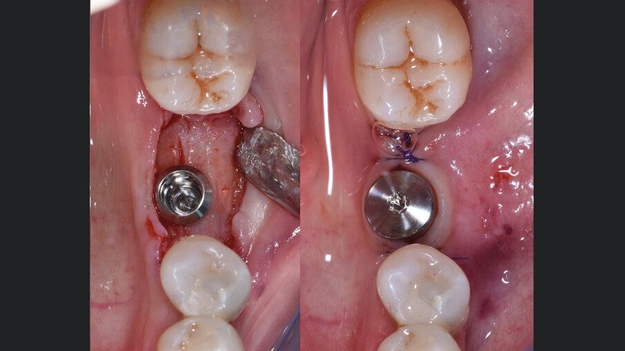 Fig. 6 - A sinistra, inserimento dell’impianto a 6 mesi dalla GBR (inserito con 50 N/cm). A destra, chiusura dei lembi e vite di guarigione per favorire la guarigione dei tessuti in vista della consegna della protesi.