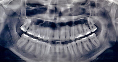 Možnosti akcelerace léčby průhlednými fóliovými aparáty