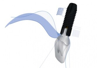 Dentsply Sirona – ASTRA TECH Implant System EV