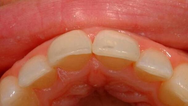 Prosta technika warstwowa do wypełnień kompozytowych wykonywanych metodą bezpośrednią