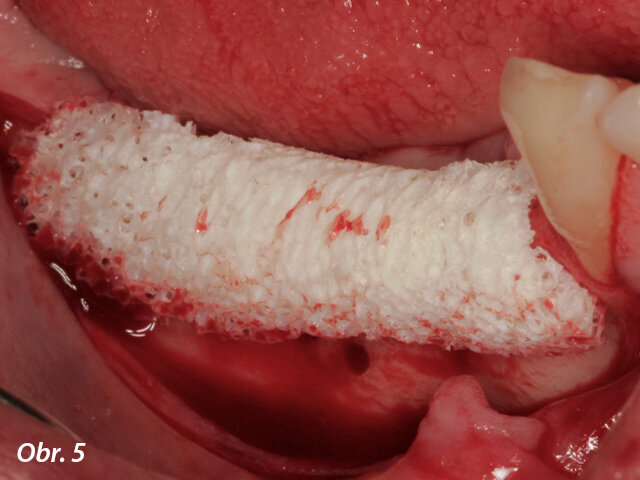 Umístění individualizovaného alogenního bločku do oblasti transplantace.