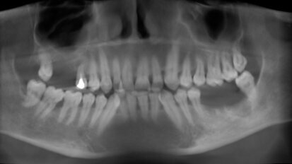 Valutazione con CBCT dell’aumento osseo verticale nella tecnica di rialzo del seno mascellare con approccio laterale: caso clinico