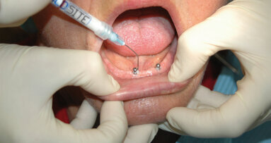 Zuverlässig Periimplantitis bekämpfen