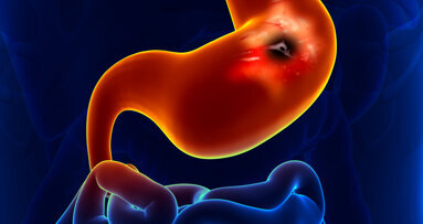 Unbehandelte Parodontitis erhöht Magenkrebsrisiko