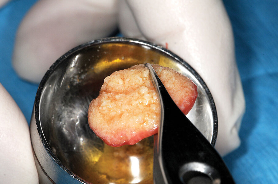 Fig. 16: The ‘gummy bone’ is used as a single mass when placing in large voids.