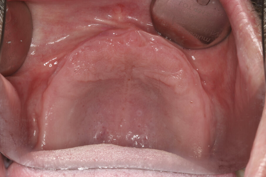 Fig. 1: Pre-op situation of the edentulous maxilla.