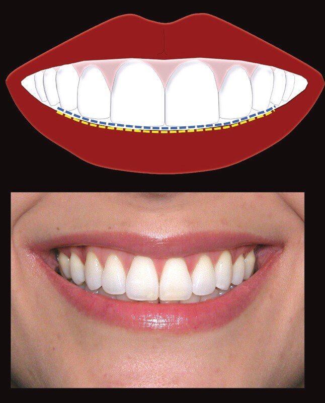 Fig 1: Consonant smile