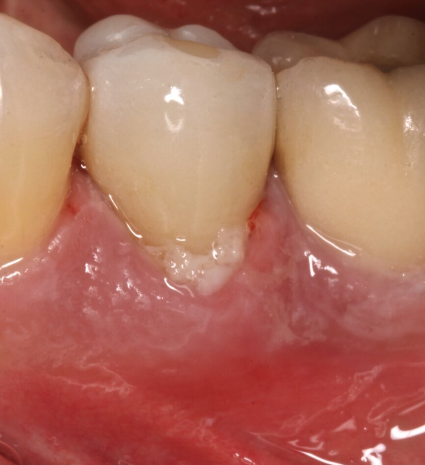 Fig. 8: Installation of the final restoration.