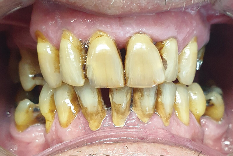 Sl. 2.0: Pacijent B, pušač pri prijemu