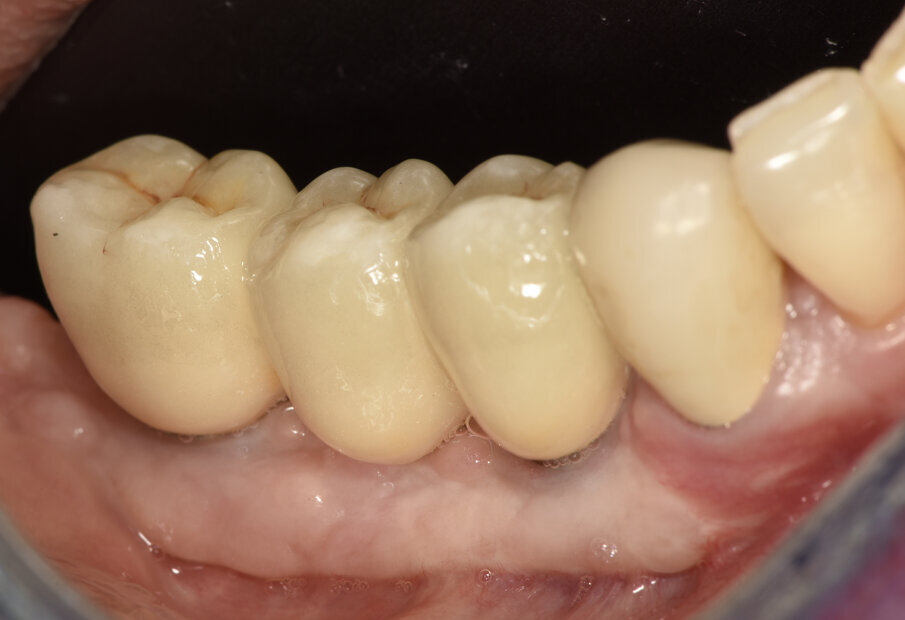 Figg. 12a, 12b_Immagine clinica e radiografica che mostrano il manufatto protesico finale. 