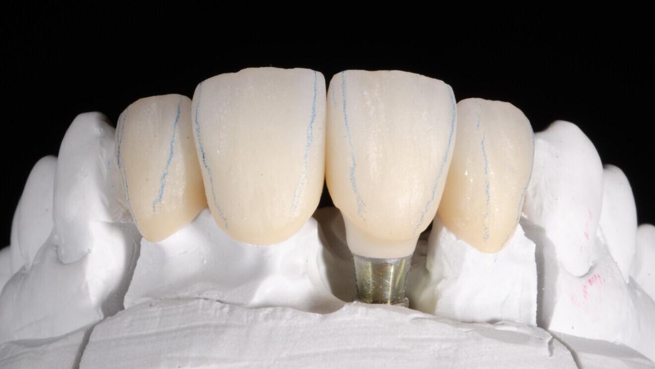 Fig. 4: Crowns prior to final shape adjustments and polishing. 