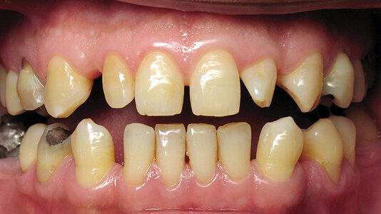 Mock-up: Vaše každodenní pomůcka v estetické stomatologii