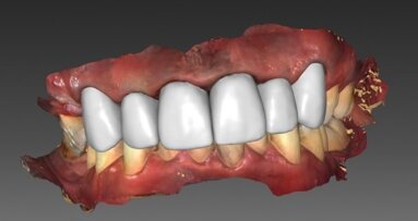 Leczenie kompleksowe z użyciem skanera wewnątrzustnego i technologii CAD/CAM – opis przypadku