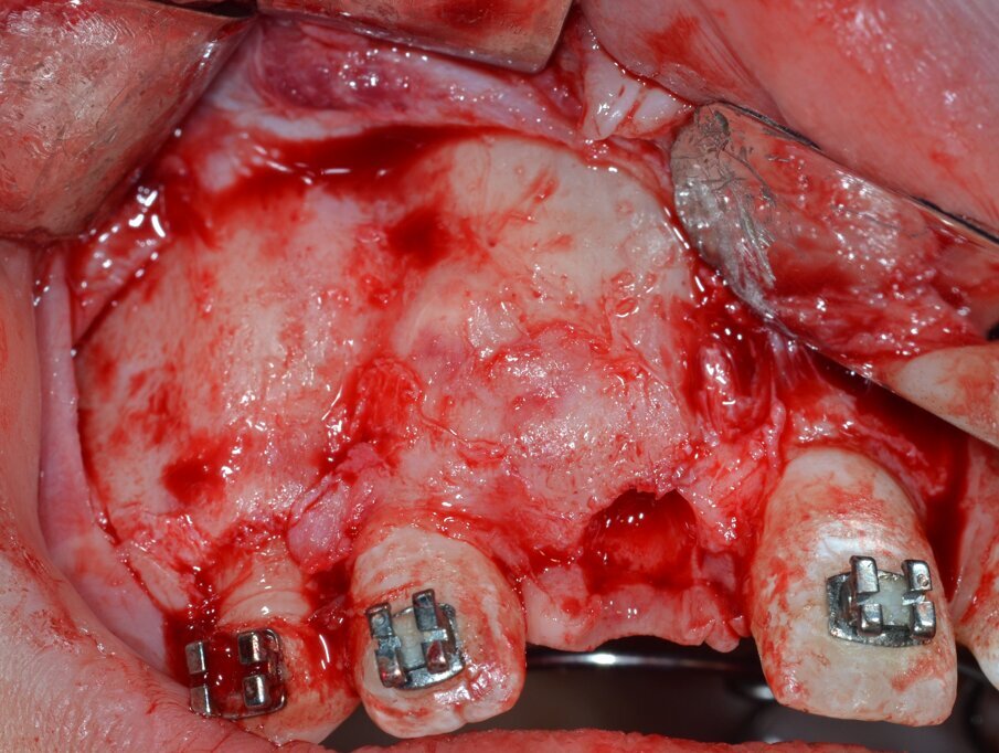 Fig. 4_Lembo a tutto spessore che espone la zona interessata dalla lesione.