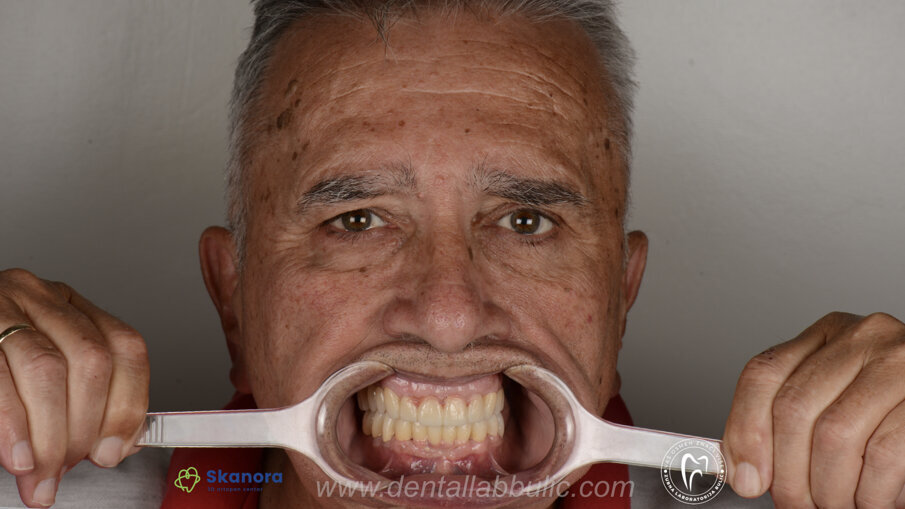 Slika 6-001 izgled definitivnog rada u ustima 