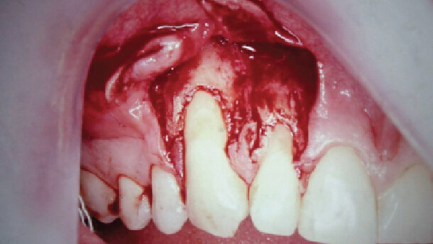 Překrytí gingiválních recesů se stalo předvídatelné díky použití resorbovatelných bariér