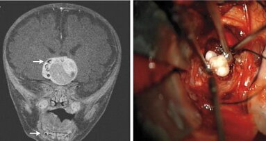 Cirurgiões descobrem dentes no tumor de cabeça de um bebê