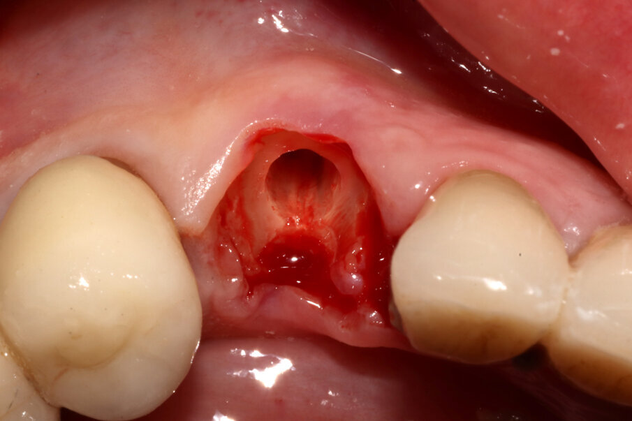 Figg. 5-7_Fasi della Socket-Shield: decoronazione, svuotamento del lume canalare e asportazione della porzione linguale della radice tramite protocollo “Preserving Nature”.