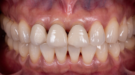 Meeting high functional and aesthetic demands with ceramic solutions