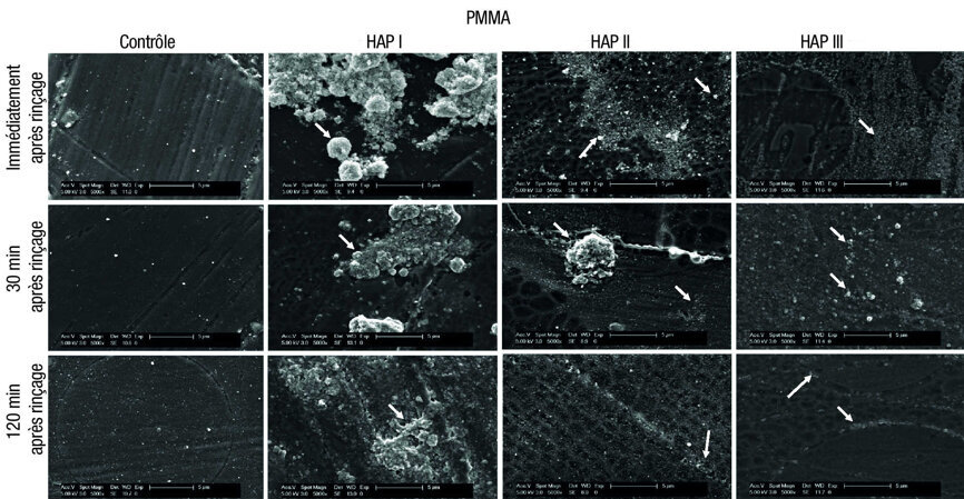 Fig. 8 : Micrographies MEB de la pellicule sous un grossissement de 5 000 fois et les nano-HAP sur les échantillons de PMMA. La formation de la pellicule et les particules d’hydroxyapatite sont visibles à trois moments d’évaluation différents : immédiatement après l’utilisation de la solution de rinçage à base de HAP I, HAP II et HAP III a 5 %, puis 30 minutes et deux heures après. Les flèches blanches indiquent les HAP accumulées sur la surface de PMMA.