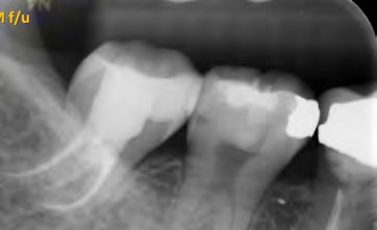 Fig. 2b: Four-month follow-up radiograph  showing reduction in the periradicular radiolucency with increased bone density, indicating favorable periapical healing. The tooth remained asymptomatic and was referred for definitive crown fabrication.