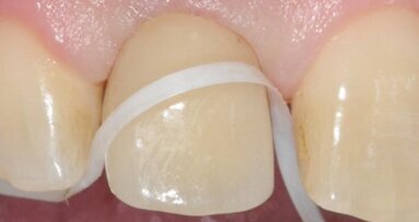 Hemijska podrška u kontroli biofilma