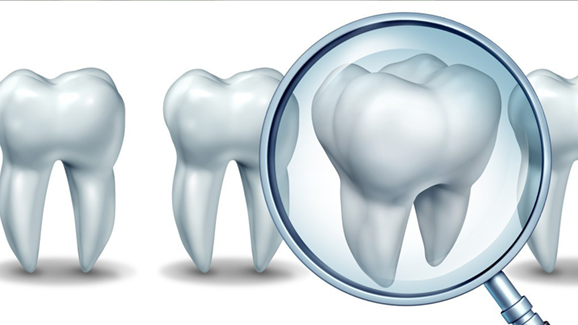 S3-Leitlinie „Fissuren- und Grübchenversiegelung“