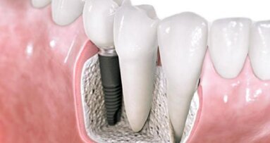 Implanty – estetyczne, bezpieczne i wcale nie takie drogie