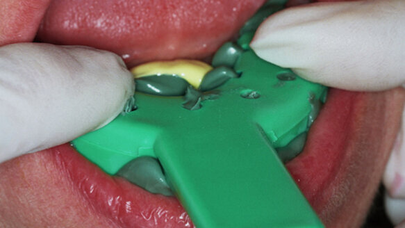 Asking your clinician for a new impression