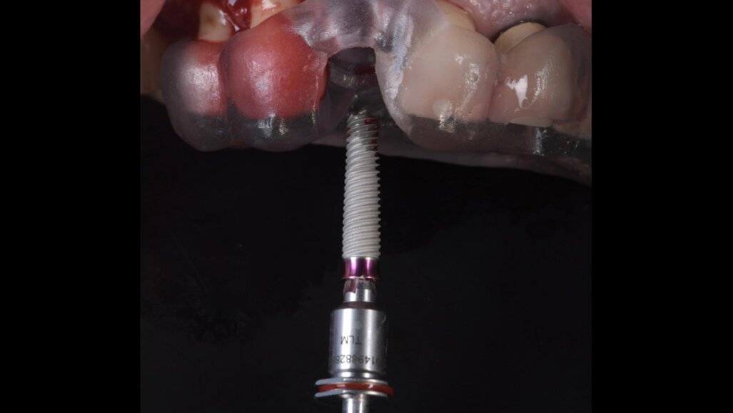 Workflow digitale nella protesizzazione immediata di un impianto abutment free