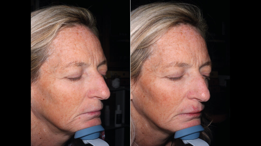 Bio-ristrutturazione palpebrale