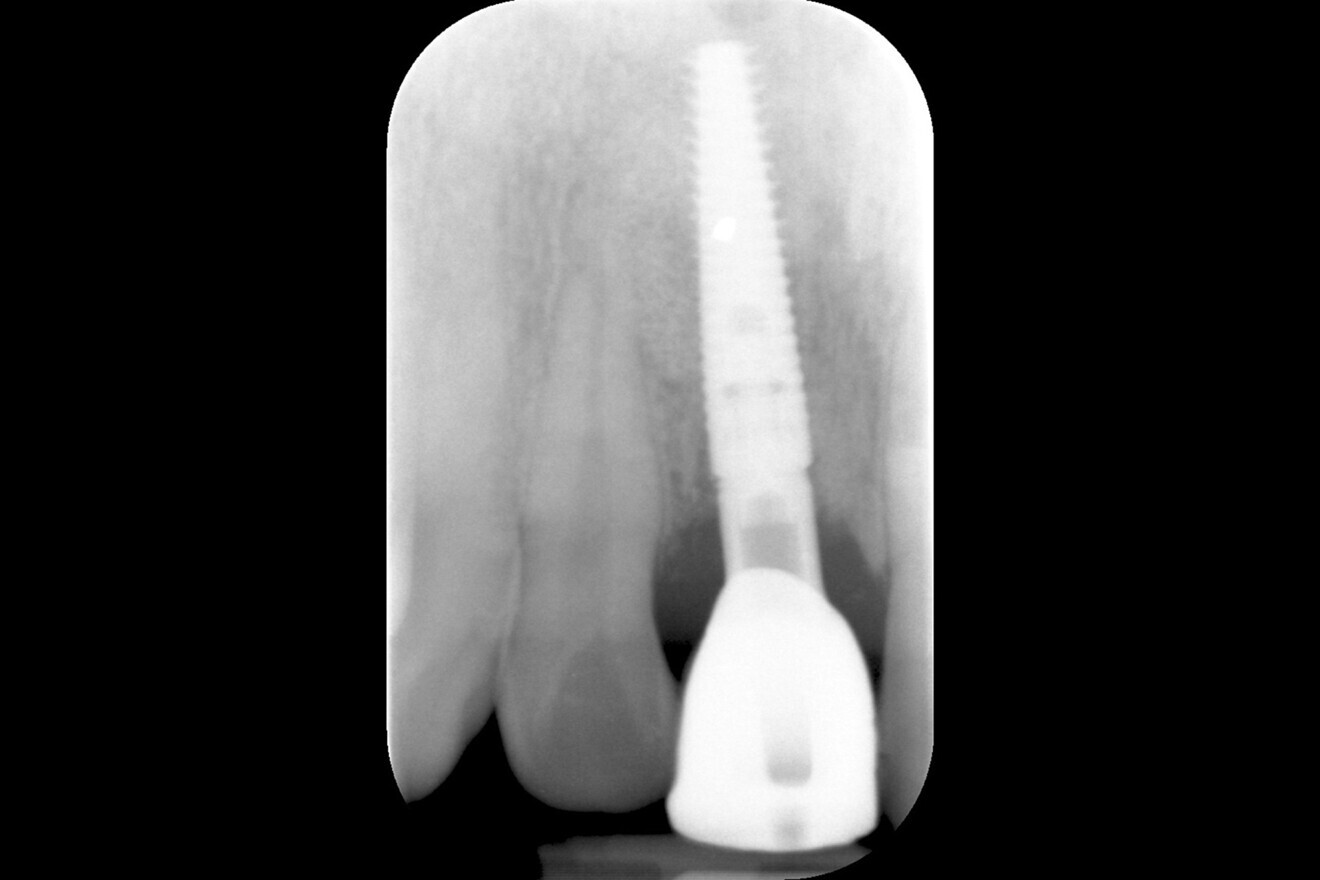 Fig. 13: Radiograph of the implant at baseline insertion of the definitive crown.