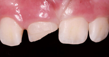 Endodontické ošetření horního středního řezáku s atypickou anatomií