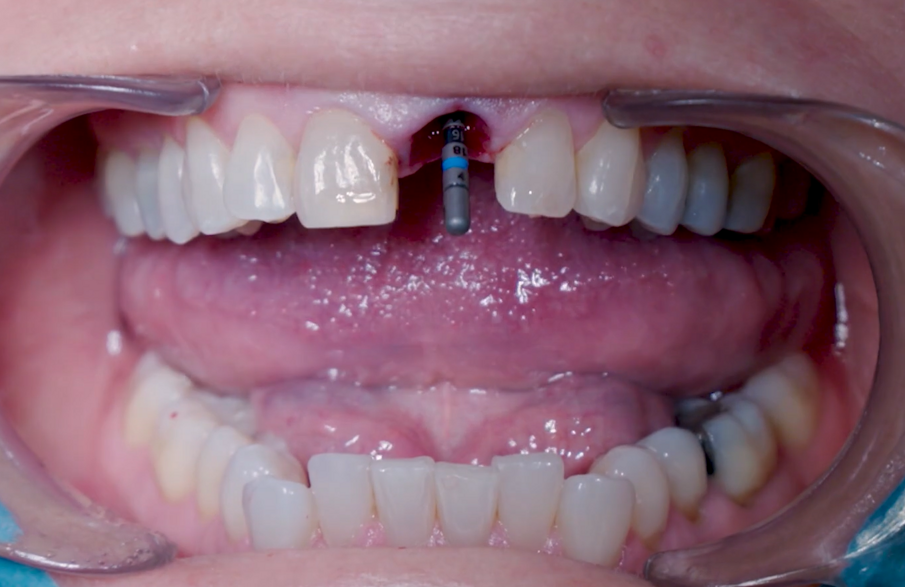 Fig. 7_Conferma 3D con perno di allineamento Ø 2,2 mm. 