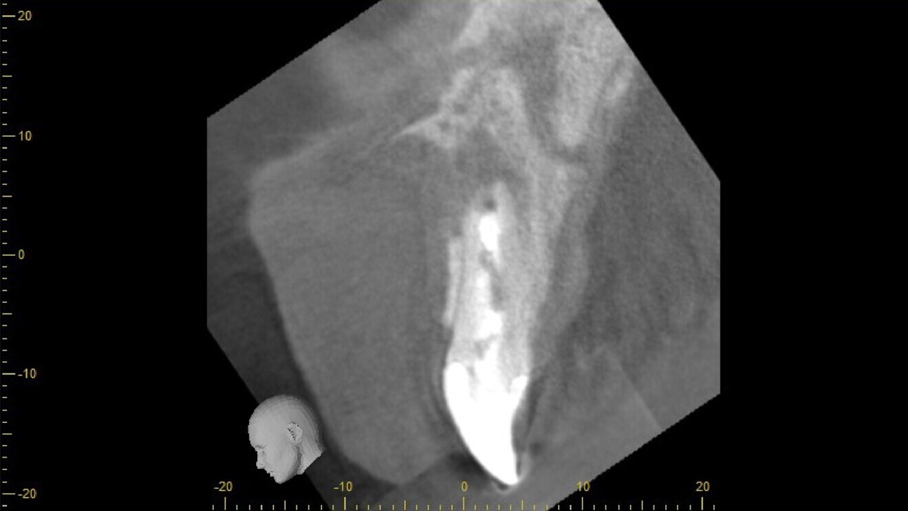 Fig. 2: CBCT scan of failing tooth #11, showing inadequate root canal treatment and apical fenestration but an intact labial-crestal plate. 