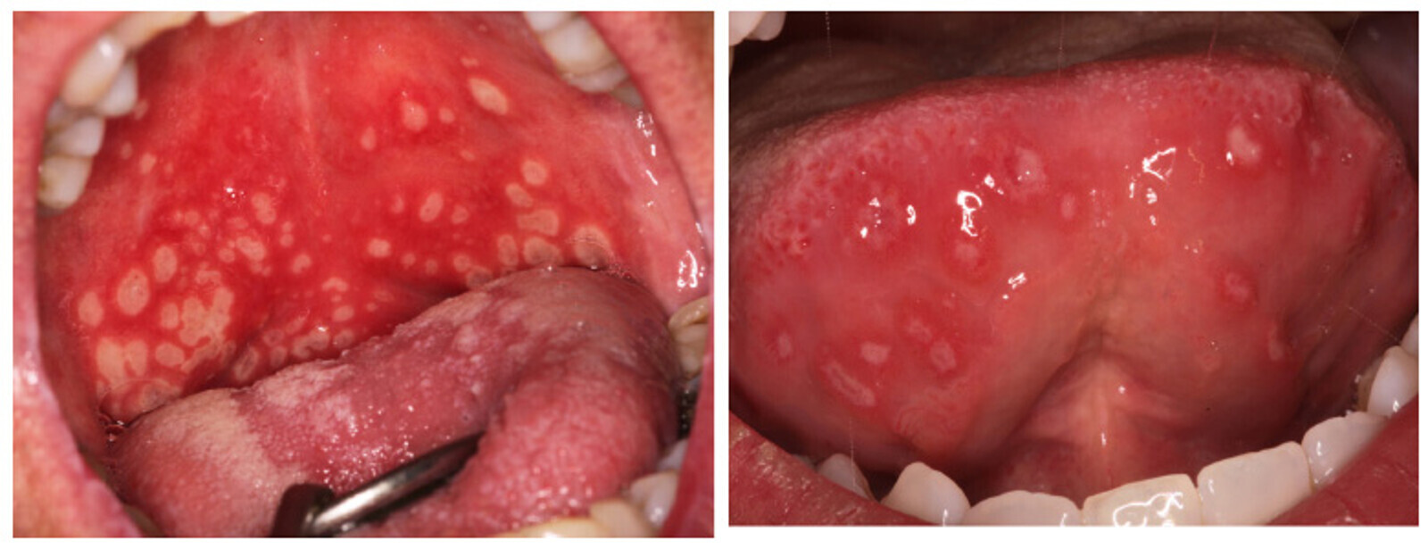 Figura 3. Las aftas herpetiformes se caracterizan por la presencia de mÃºltiples aftas pequeÃ±as muy dolorosas, localizadas en cualquier parte de la boca.