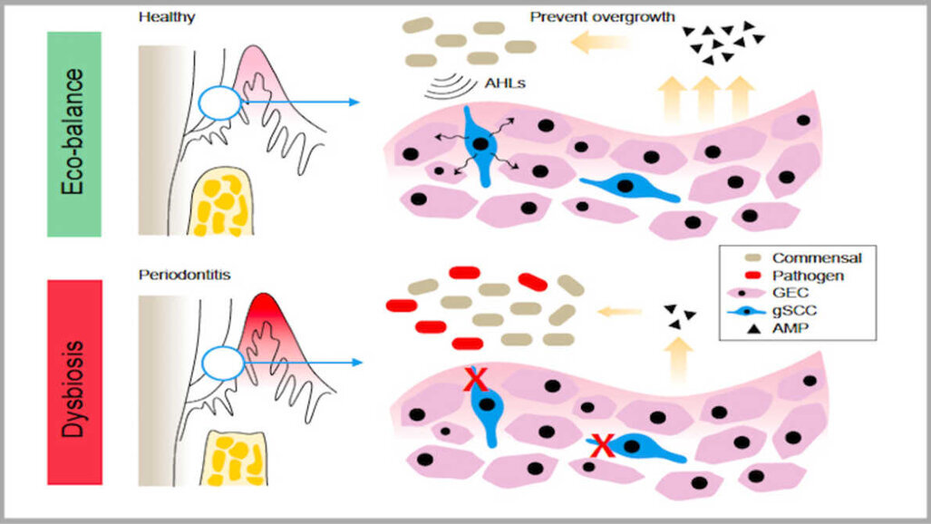 В гингивата са открити клетки, които предпазват от пародонтит