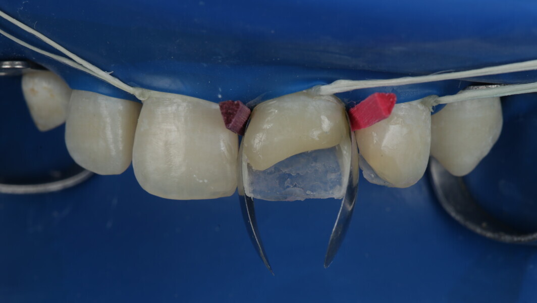 Fig 23: Interproximal build-up was done on both mesial and distal side.