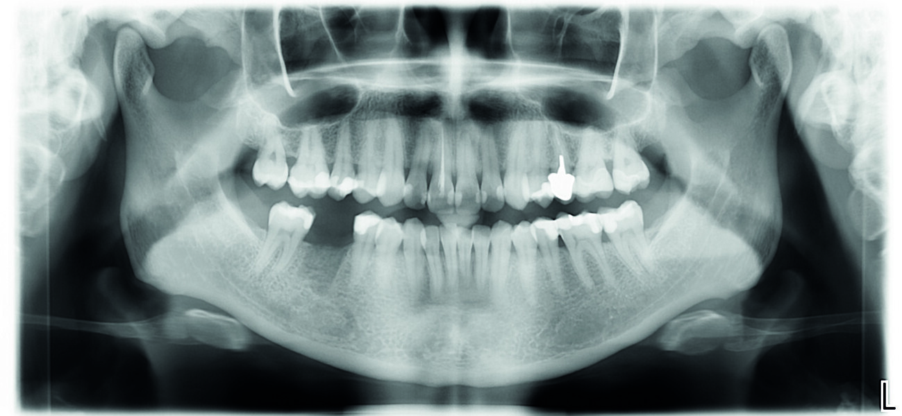 Fig. 1 : Radio panoramique, on visualise bien le secteur édenté en 46. 