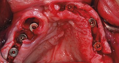 Implantološka rehabilitacija pacijenata sa rascepom