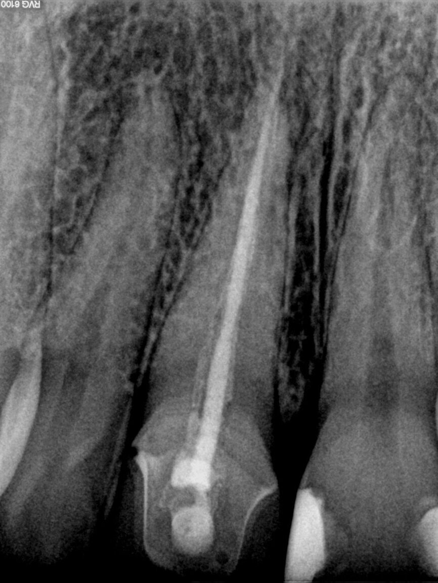 Fig. 1: Conventional radiograph of an endodontically treated tooth #11 and cold-sensitive tooth #12 compared with CBCT imaging showing the presence of a large apical bone defect (taken at a two-day interval).
