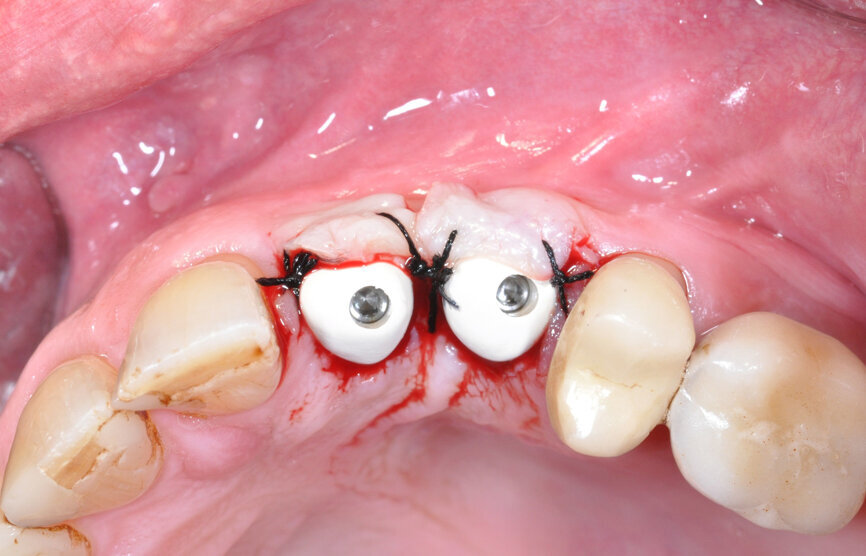 PEEK gingiva formers from Camlog. (Image: Inga Boehncke)