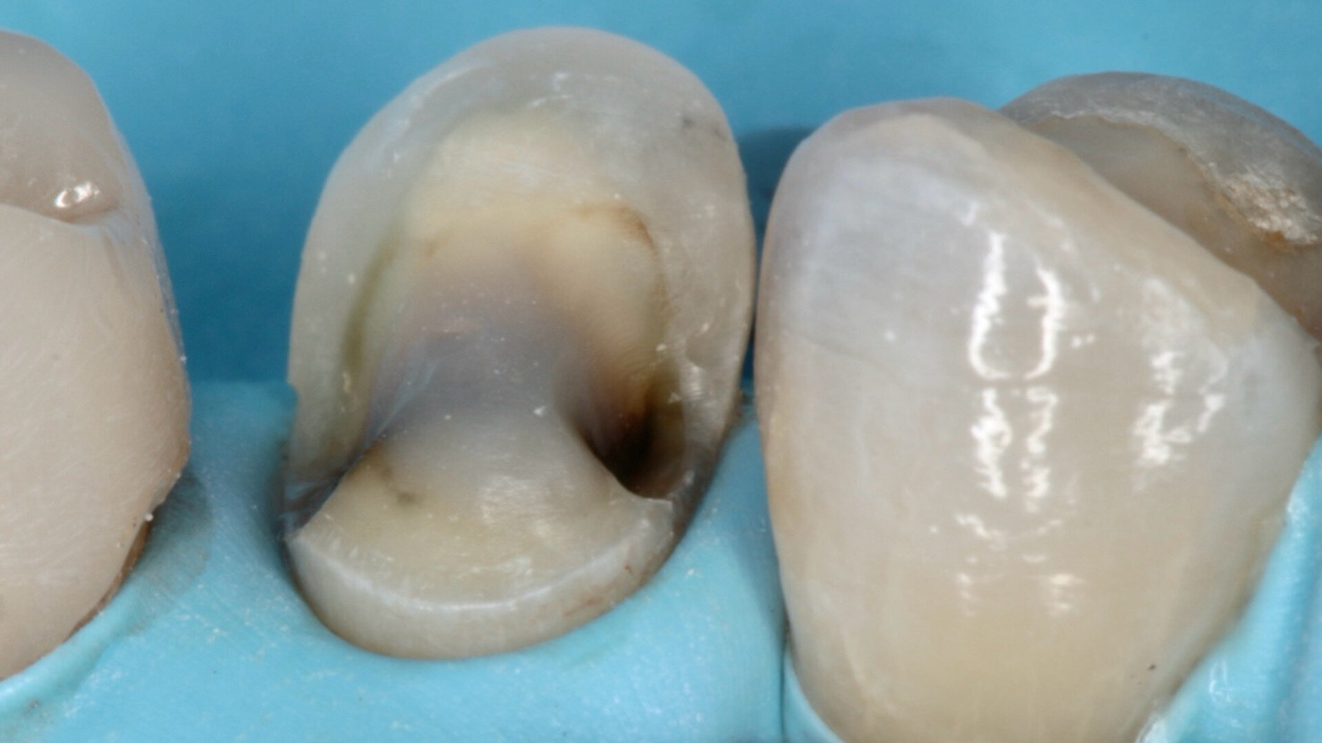 Les restaurations partielles collées postérieures en céramique – le point de vue du Québec