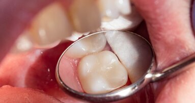 Study analyses MB2 root canal prevalence among world population