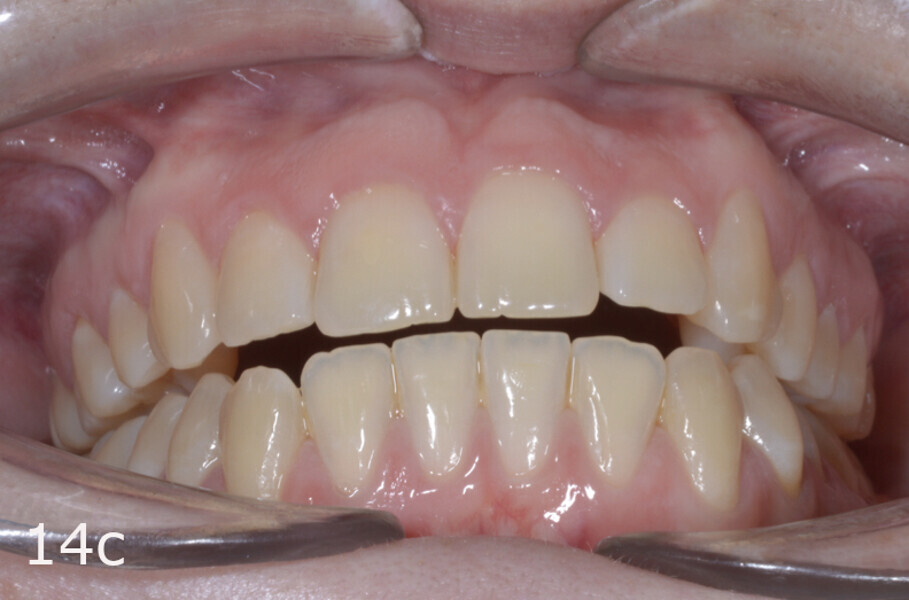 Figs. 14a–h: Intra-oral comparison of the situation (a, d, e & h) before and (b, c, f & g) after treatment.