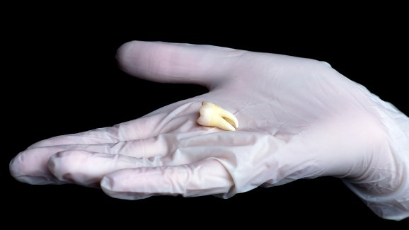 Un análisis de los dientes ofrece mayor precisión para detectar la edad